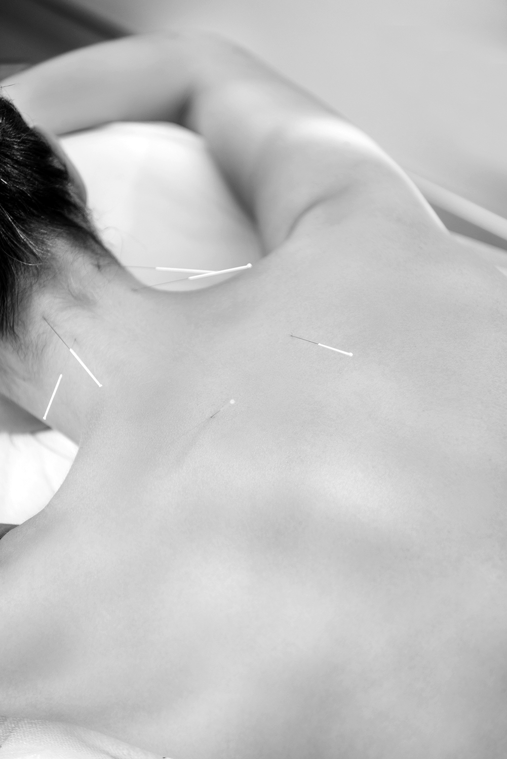 partial view of woman with needles on body having acupuncture therapy in spa salon